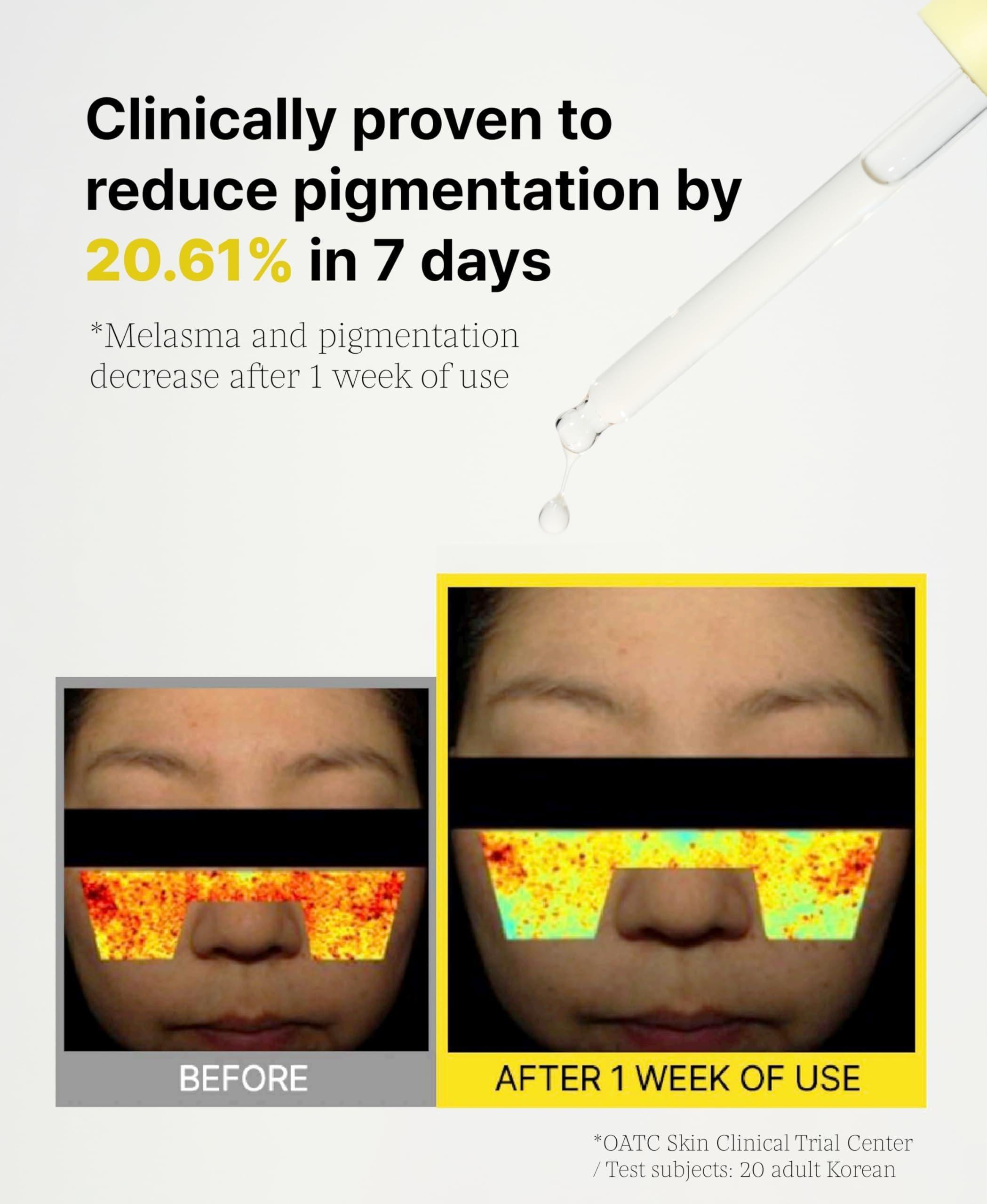 Before and after results showing 3% TXA vitamin serum for dark spots, reducing pigmentation by 20.61% in 7 days.