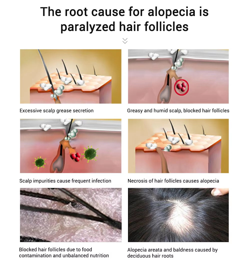Illustration of the root cause for alopecia, showing paralyzed hair follicles and scalp conditions affecting hair growth.