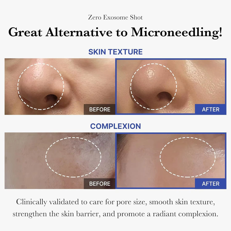 Before and after showing skin texture and complexion improvements using Zero Exosome Shot alternative to microneedling.
