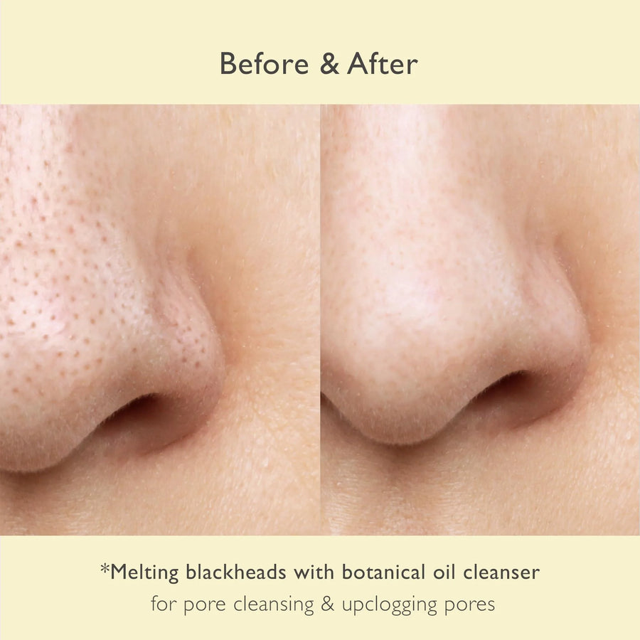Before and after image showing the effectiveness of makeup cleansing oil for blackheads on unclogged pores.