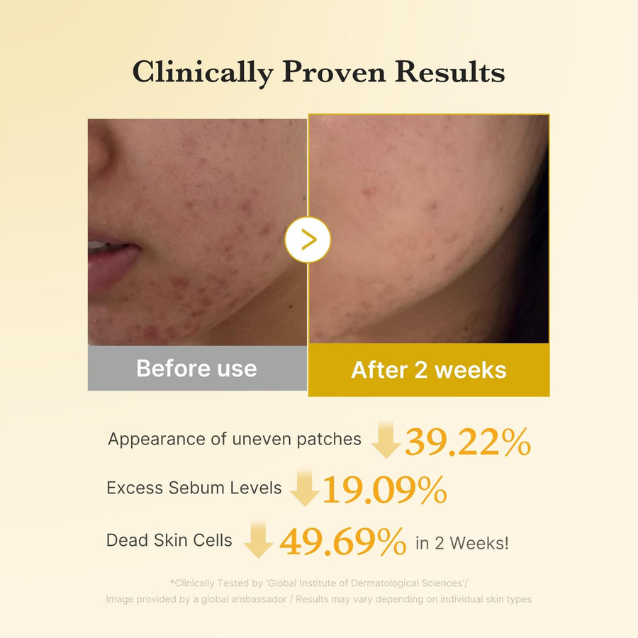 Before and after results of using kojic acid turmeric toner pads showing improved skin texture in 2 weeks.