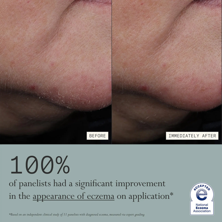Before and after application of Skin Mercy Recovery Cream showing significant improvement in the appearance of eczema.