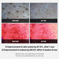 Before and after results of Medicube Red Succinic Acid Peeling Pads showing skin improvement statistics.