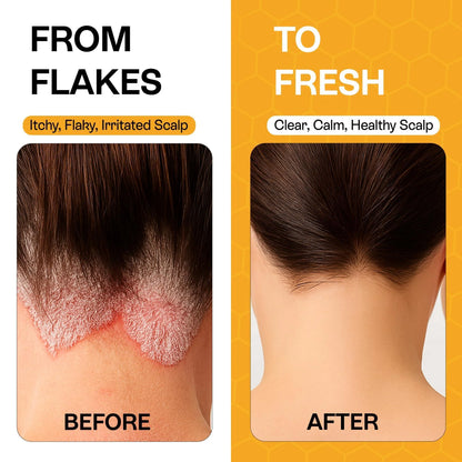 Psoriasis Shampoo for Dry Itchy Scalp Psoriasis Scalp Treatment for Eczema Relief Seborrheic Dermatitis Ringworm &amp; Folliculitis Itchy Scalp Shampoo for Flakes Acne with Manuka Honey